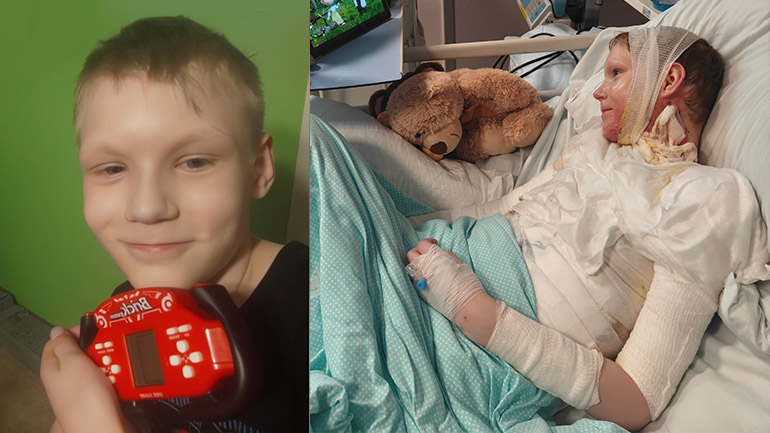 Ogień poparzył mu całe ciało